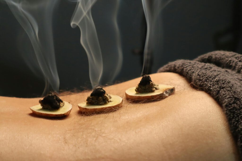 Moxibustion-Behandlung auf dem Rücken.